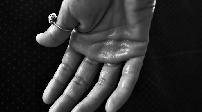 טיפול בזיעת יתר